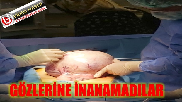 SURUÇ DEVLET HASTANESİNDE YAPILAN AMELİYATIN SONUCU ŞAŞIRTTI 